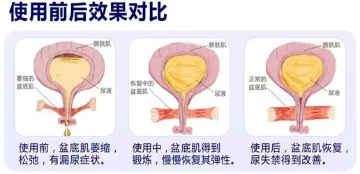 关爱女性盆底肌 健康性福添活力